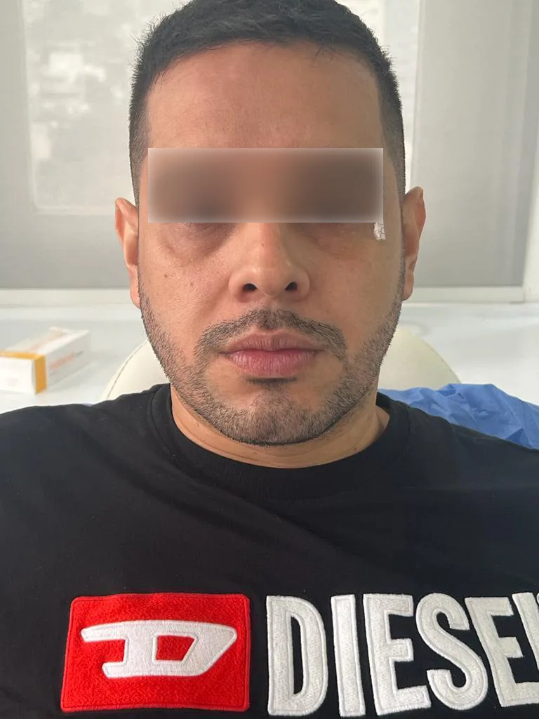 Acido Hialuronico en Ojeras Antes
