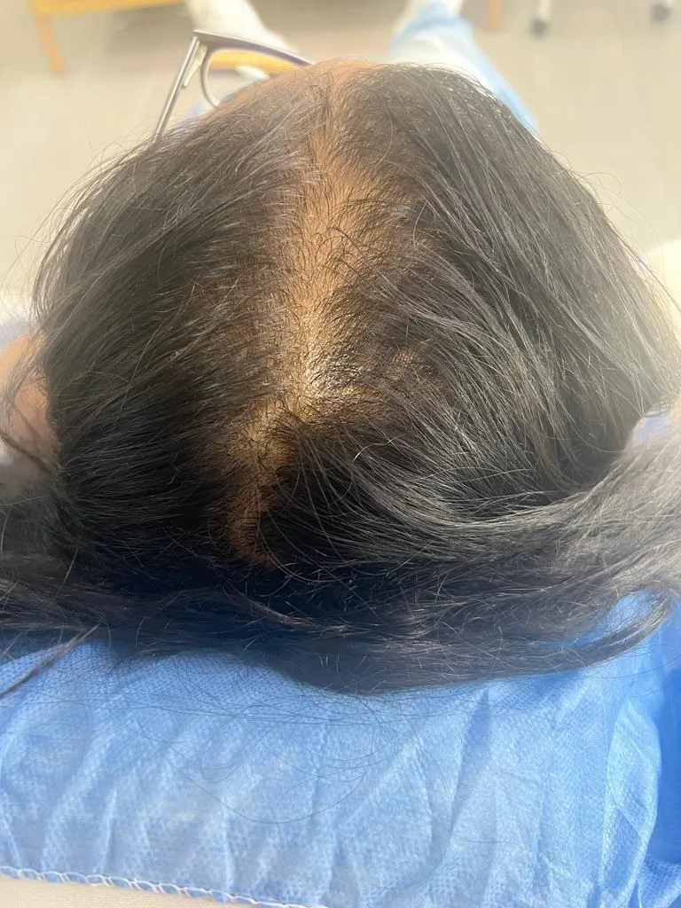 Alopecia Androgenerica Antes