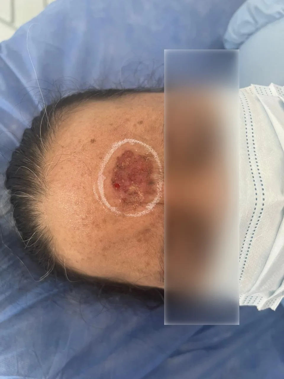 Reseccion de carcinoma basocelular antes