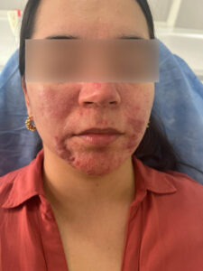 Rosacea Severa Antes