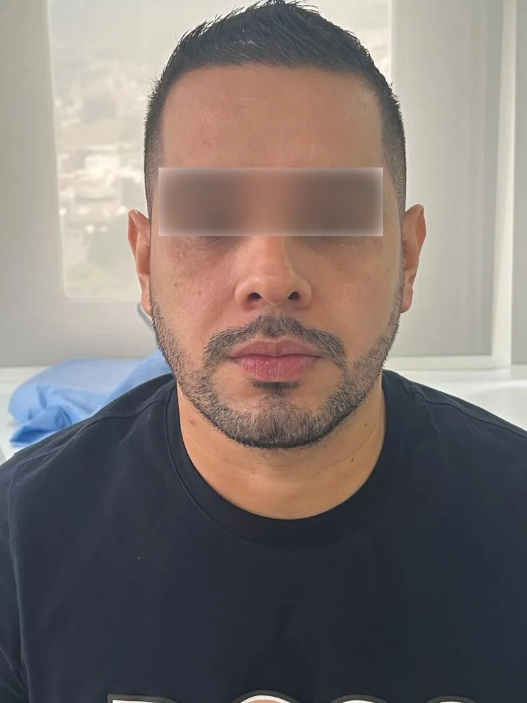 Acido Hialuronico en Ojeras Despues