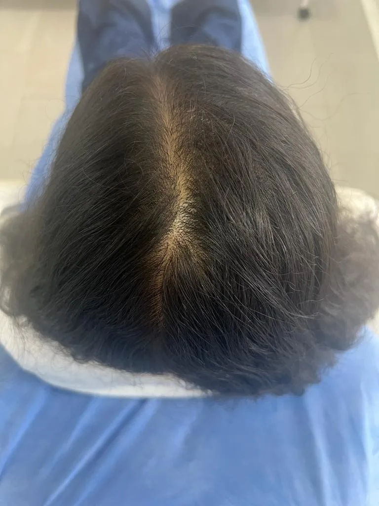 Alopecia Androgenerica Despues