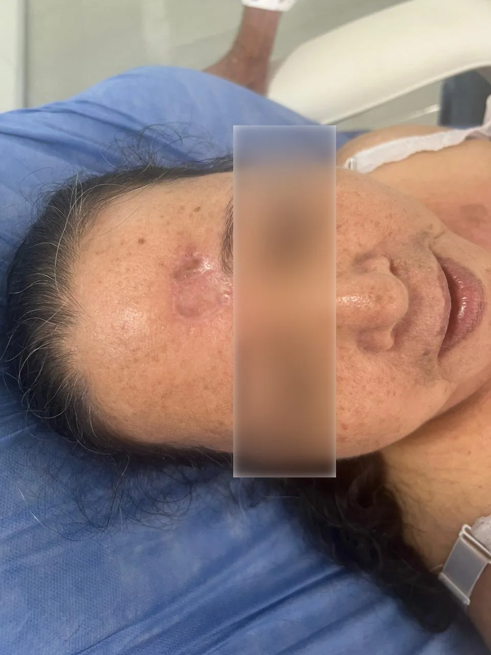 Reseccion de carcinoma basocelular despues