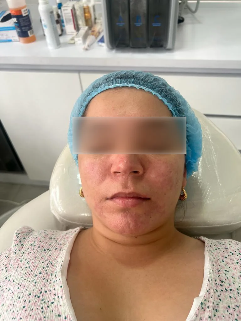 Rosacea Severa Despues