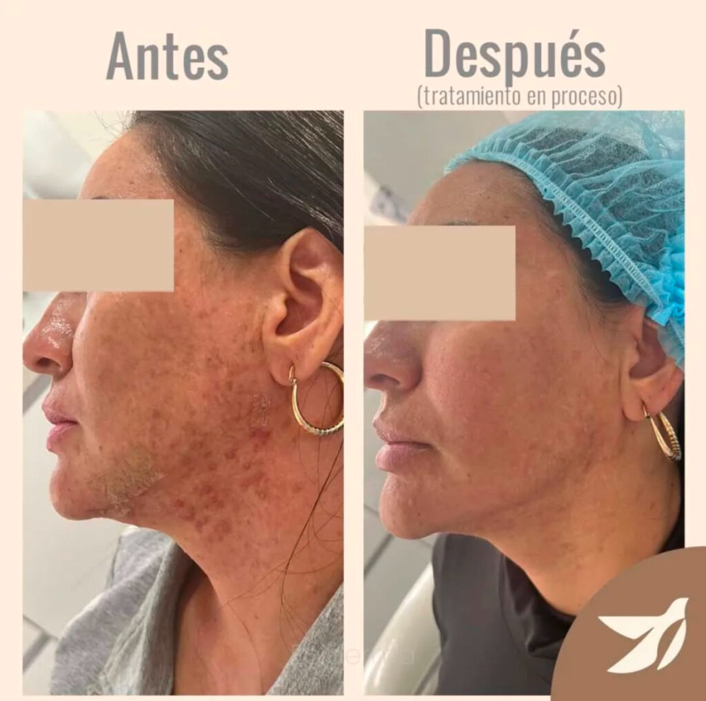 como mejorar el acne