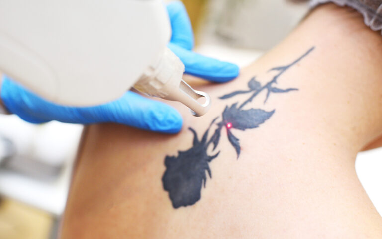 Remoción de Tatuajes
